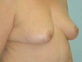 Patient # 30198 Before Photo # 5