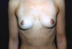 Patient # 98589 Before Photo # 1
