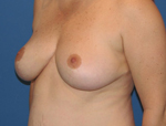 Patient # 28125 After Photo # 4
