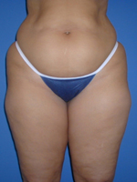 Patient # 89335 Before Photo # 1