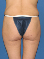 Patient # 12717 Before Photo # 1