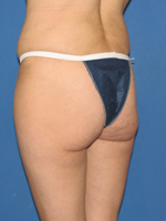 Patient # 12717 Before Photo # 3