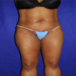 Patient # 28610 After Photo # 2