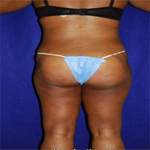 Patient # 28610 After Photo # 4