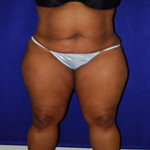 Patient # 28610 Before Photo # 1