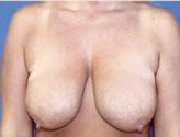 Patient # 37721 Before Photo # 1