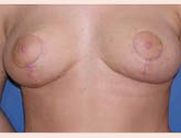 Patient # 13956 After Photo # 2