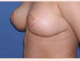 Patient # 13956 After Photo # 4