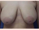 Patient # 13956 Before Photo # 1