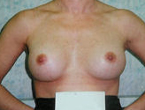 Patient # 16272 After Photo # 2