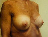 Patient # 20617 After Photo # 4