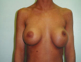 Patient # 59772 Before Photo # 1