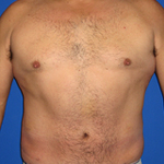 Patient # 93590 After Photo # 2
