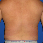 Patient # 93590 After Photo # 4