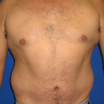 Patient # 93590 Before Photo # 1