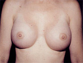 Patient # 69972 After Photo # 2