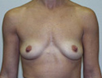 Patient # 48271 Before Photo # 1