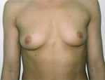 Patient # 50978 Before Photo # 1
