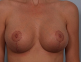 Patient # 36809 After Photo # 2