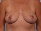 Patient # 54025 After Photo # 2