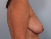 Patient # 54025 Before Photo # 5