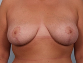 Patient # 56903 After Photo # 2