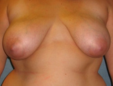 Patient # 56903 Before Photo # 1