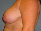 Patient # 56903 Before Photo # 5