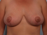 Patient # 62055 After Photo # 2