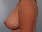 Patient # 62055 After Photo # 6