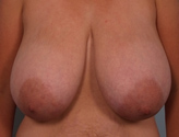Patient # 62055 Before Photo # 1