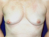 Patient # 49211 Before Photo # 1