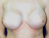 Patient # 23295 After Photo # 2
