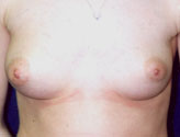 Patient # 23295 Before Photo # 1