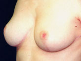 Patient # 19382 After Photo # 6