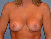 Patient # 44479 After Photo # 2