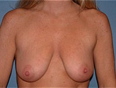 Patient # 44479 Before Photo # 1