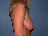 Patient # 44479 Before Photo # 3
