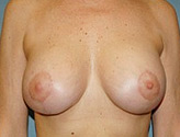 Patient # 76076 After Photo # 2