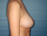 Patient # 27083 After Photo # 4