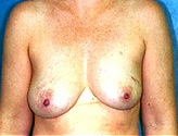 Patient # 54366 Before Photo # 1