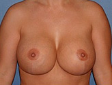 Patient # 37049 After Photo # 2