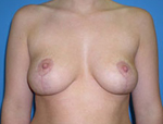 Patient # 27684 After Photo # 2