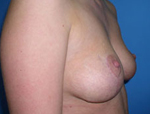 Patient # 27684 After Photo # 4