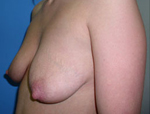 Patient # 27684 Before Photo # 5
