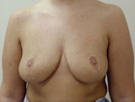 Patient # 84450 After Photo # 2