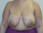 Patient # 84450 Before Photo # 1