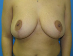 Patient # 48609 After Photo # 2
