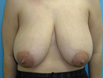 Patient # 48609 Before Photo # 1