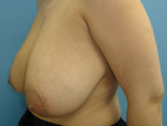 Patient # 48609 Before Photo # 3
